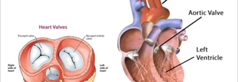 Aortic Valve Repair Treatment cost in India