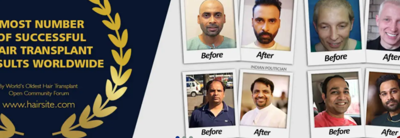 A's Clinic Hair Transplant Delhi – Best Hair Transplant Clinic In Delhi, NCR